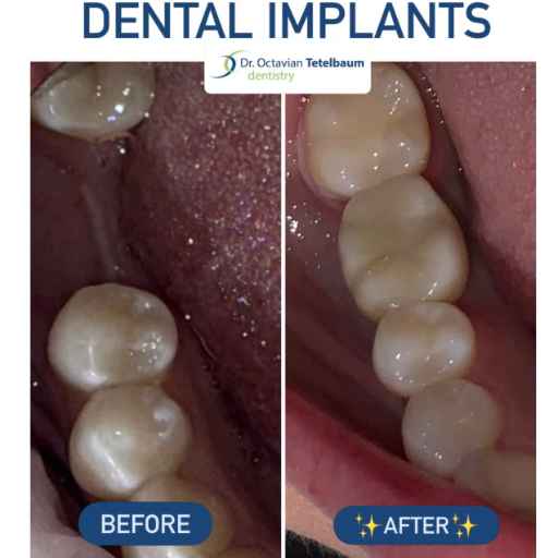 Before and after results of a dental implant and crown replacing a missing tooth